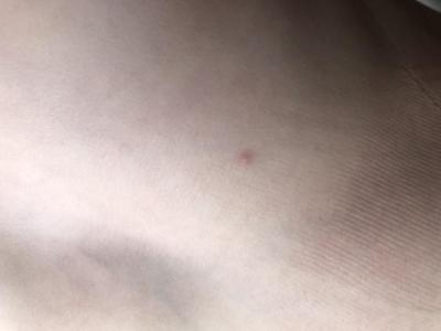 Zvířata | Stenice nebo blecha? Od ceho kousnuti?