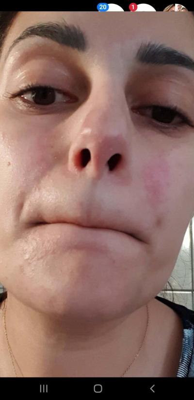 Alergie a ekzémy | Dermatitida nebo ekzém?