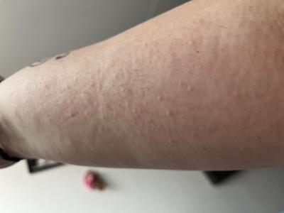 Zdravotní potíže dospělých | Vyrážka v těhotenství 24tt