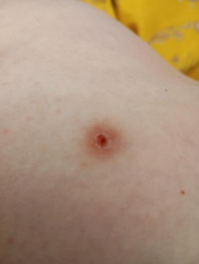 Zdravotní potíže dospělých | Štěnice, nebo blecha?