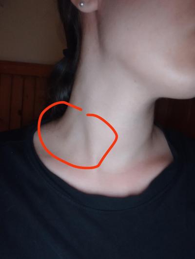 Zdravotní potíže dospělých | Boulička na krku/uzlina?