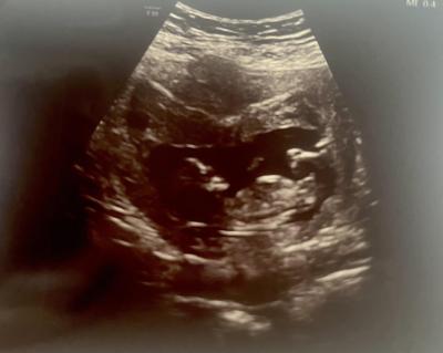 Těhotenství | Pohlaví miminka podle ultrazvuku