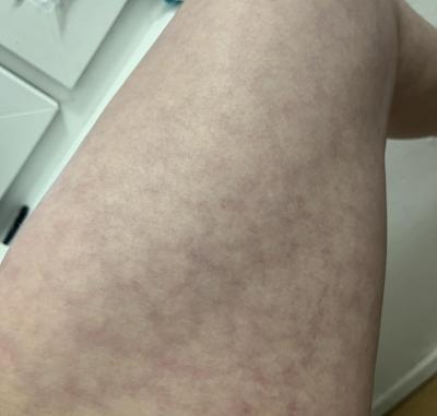 Zdravotní potíže dospělých | Žíly na stehnech