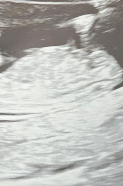 Těhotenství | Ultrazvuk 12týden