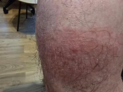 Alergie a ekzémy | Flek na noze pod kolenem