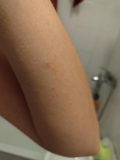 Alergie a ekzémy | Myslíte, že by to mohl být svrab?