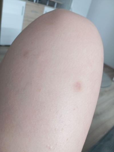 Alergie a ekzémy | Vyrážka a modřiny