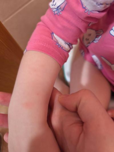 Dětské nemoci | Neštovice s pomalým průběhem?