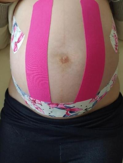 Porodnice Třinec, Gynekologicko-porodnické oddělení: v porodnici umějí ulevit i pomocí tejpu