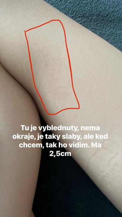 Dětské nemoci | Co je to za fleky na těle? Mám strach z neurofibrózy