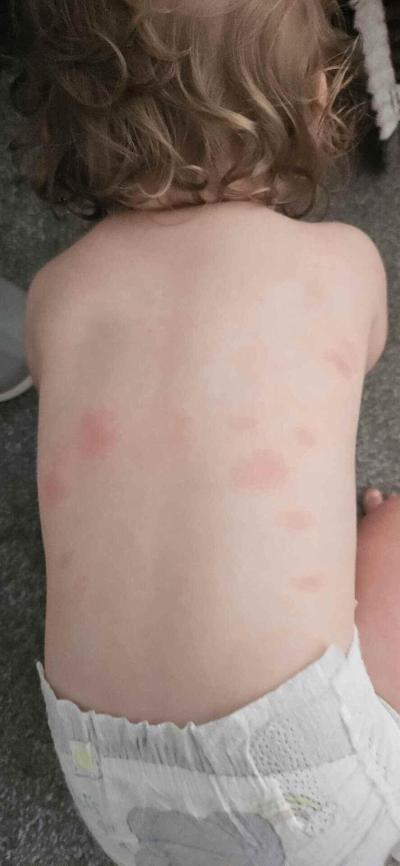 Batole (12 až 36 měsíců) | Co to je za fleky nebo vyrazku?