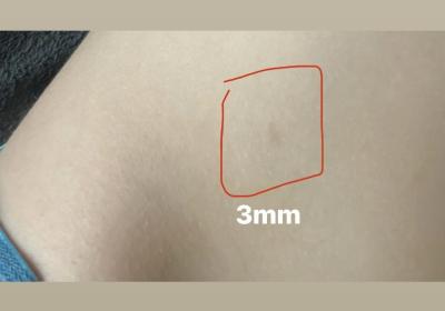 Dětské nemoci | Co je to za fleky na těle? Mám strach z neurofibrózy