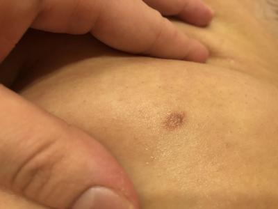 Alergie a ekzémy | Červené kolečka na kůži