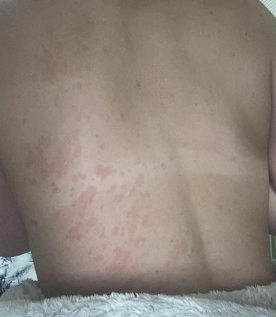 Alergie a ekzémy | Tmavé Skvrny na zádech