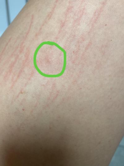 Alergie a ekzémy | Svědivé pupence