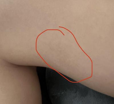 Dětské nemoci | Co su to za flaky na tele?