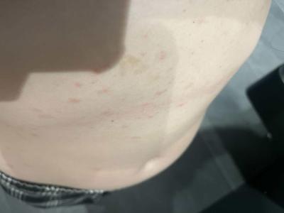 Zdravotní potíže dospělých | Pupínky na těle
