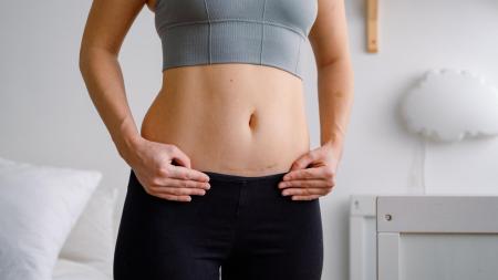 Jizva po císařském řezu: Nejčastější chyby maminek při hojení. Co udělat hned a čemu se raději vyhnout