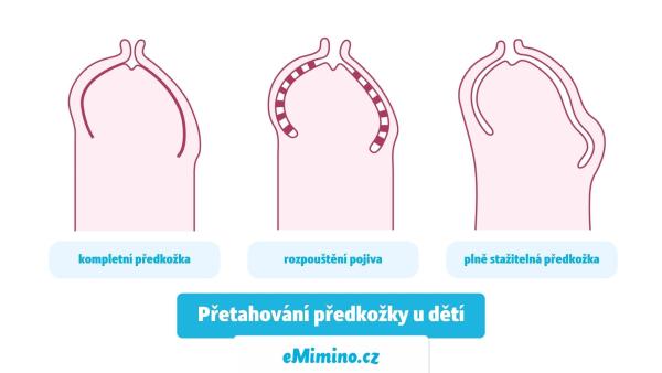 Pozor! Odborníci se shodují, že není vhodné násilím přetahovat předkožku přes žalud.