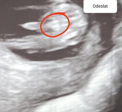 Těhotenství | Pupeční šňůra nebo bimbas? :D