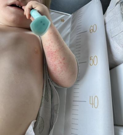 Alergie a ekzémy | Ekzém po celém těle