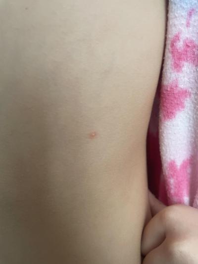 Dětské nemoci | Jsou to neštovice?