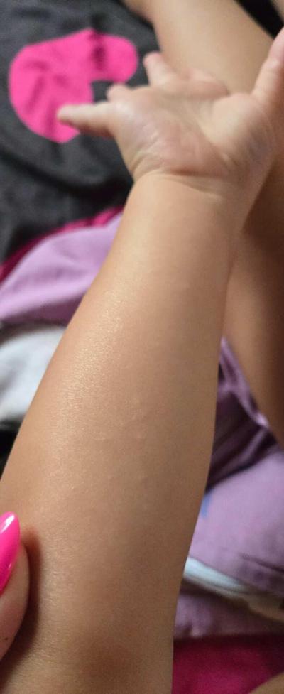 Dětské nemoci | Co to může být za drobné pupínky?