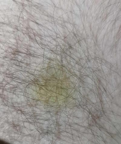 Zdravotní potíže dospělých | Modřiny  žluté