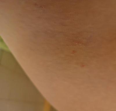 Alergie a ekzémy | Co s tím? Jsem bezradná