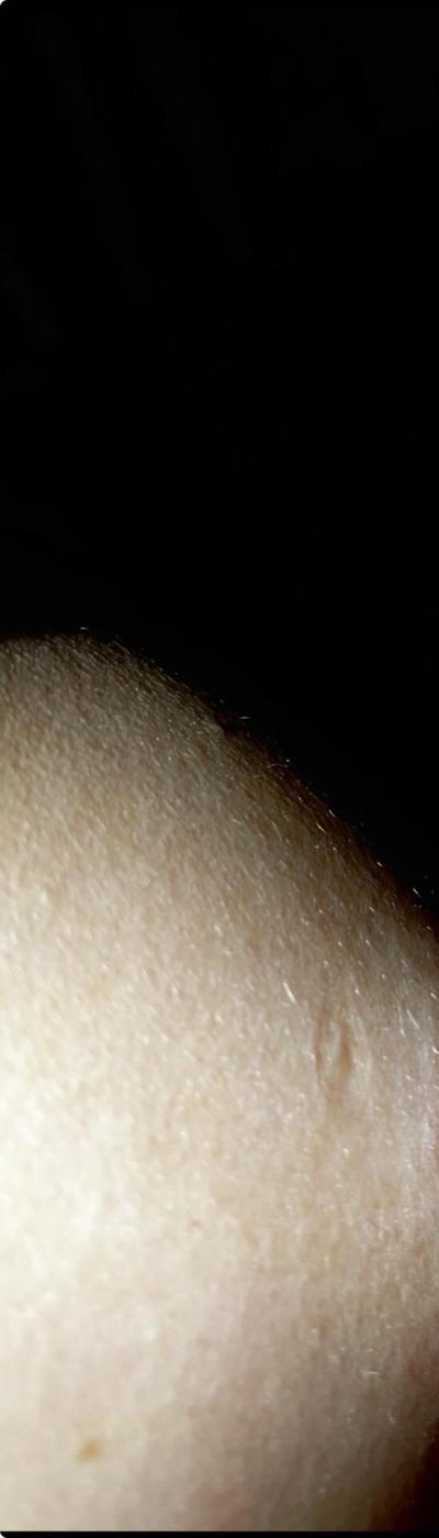 Zdravotní potíže dospělých | Prohlubeň pod bradavkou