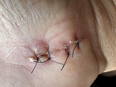 Zdravotní potíže dospělých | Zanícená rána po operaci karpálních tunelu