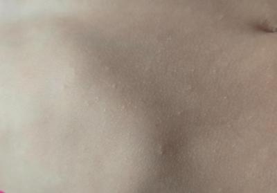 Dětské nemoci | Co to může být za drobné pupínky?