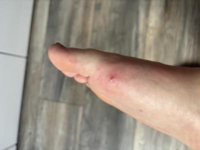 Zdravotní potíže dospělých | Bublinky na chodidlech