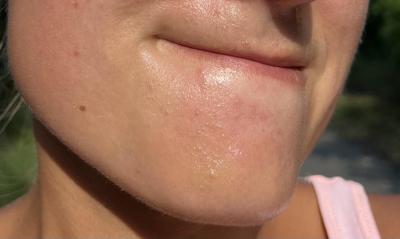 Zdravotní potíže dospělých | Je tohle perioralní dermatitida či klasické akné?