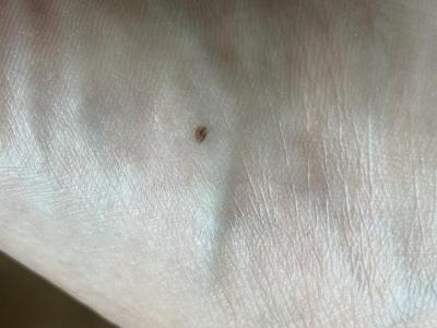 Zdravotní potíže dospělých | Piha na chodidle, nebolí