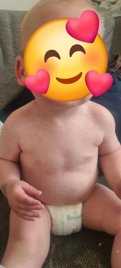 Alergie a ekzémy | FOTO: Náhlá vyrážka na bříšku a zádech