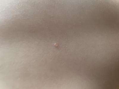 Dětské nemoci | Jsou to neštovice?