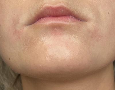 Alergie a ekzémy | Perioralni dermatitida nebo ekzém?
