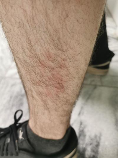 Zdravotní potíže dospělých | Vyrážka na nozee