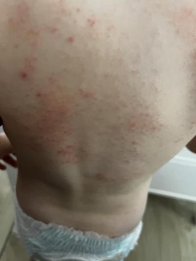 Alergie a ekzémy | Co by to mohlo být za vyrážku? Alergie, prášek?