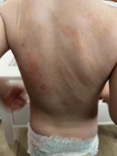 Alergie a ekzémy | Co by to mohlo být za vyrážku? Alergie, prášek?