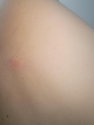 Zdravotní potíže dospělých | Je to stipanec od komara?