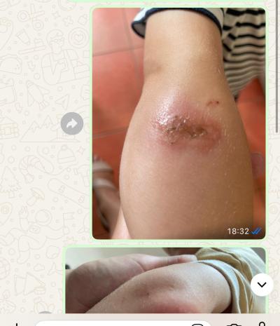 Alergie a ekzémy | 4leté dítě a opakující se pupeny na těle