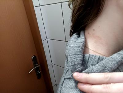Alergie a ekzémy | Ekzém, plíseň?