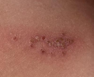 Dětské nemoci | Opar, herpes dítěte?