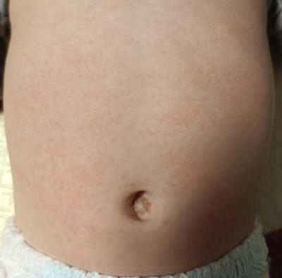Alergie a ekzémy | Náhlá vyrážka na bříšku a zádech