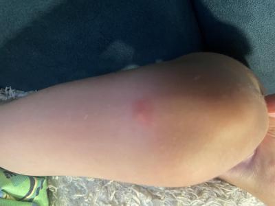 Alergie a ekzémy | 4leté dítě a opakující se pupeny na těle