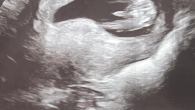 Těhotenství | Pupeční šňůra nebo bimbas? :D