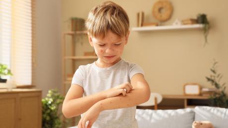 Cyril Děckař radí: Plané neštovice už není třeba prodělat. Přesto chtějí někteří rodiče svoje děti nakazit